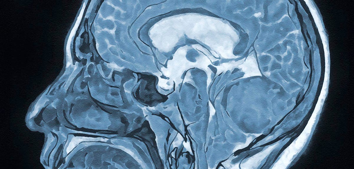 Hypnose bei Hirnoperationen: Eine neue Methode