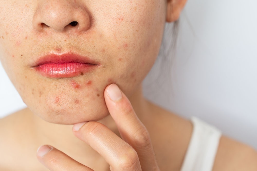 Effektive Behandlung und psychische Belastung durch Akne